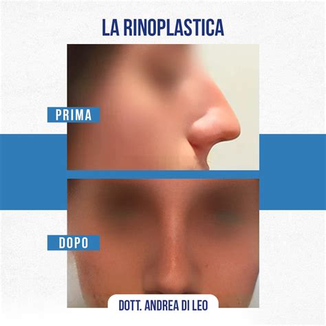 Rinoplastica Milano Chirurgia Plastica Naso Col Dott Di Leo