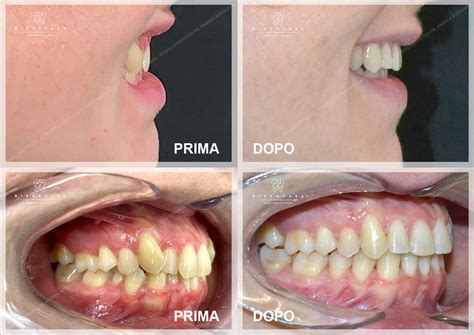 Apparecchio Denti Ortodonzia Adulto Monza E Brianza Studio