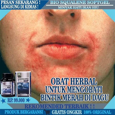 Jual Obat Ruam Kemerahan Dan Bintik Di Area Dagu Dan Hidung Obat Alami