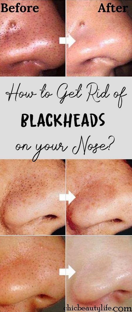 How To Remove Blackheads On Nose Instantly Howotremo