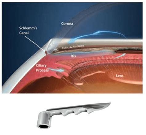 What Is Micro-Invasive Glaucoma Surgery (Migs)? - Fraser Valley ...