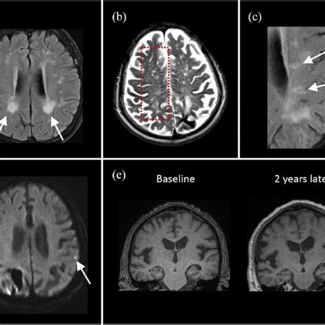 Ischemic Presentations In Cerebral Amyloid Angiopathy A T2 Flair Mri