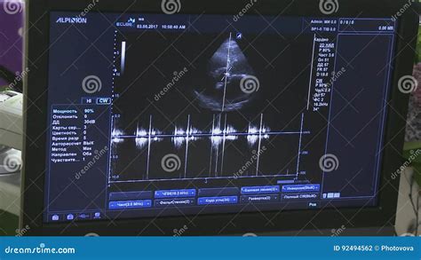 Medical Ultrasound Scan Heart Echocardiogram Stock Footage Video Of