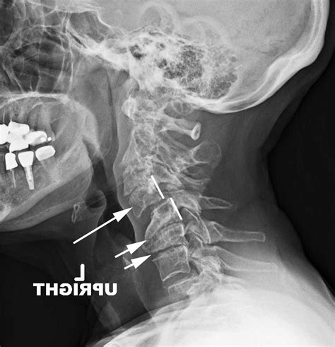 Cervical Degenerative Spondylolisthesis Spine Specialist Vail