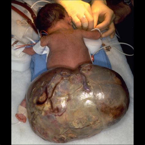 Newborn With A Sacral Mass Pediatric Radiology Case Pediatric