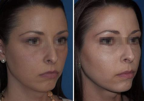 Fillers Midface Richmond Va Filler Augmentation Of Cheeks