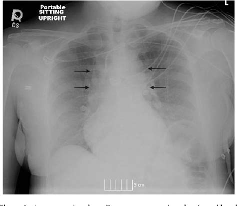 Saddle Pulmonary Embolism