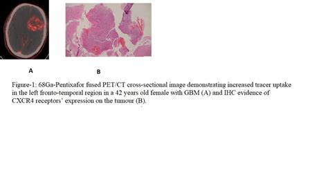 68Ga Pentixafor PET CT In Vivo CXCR4 Imaging For The Detection Of