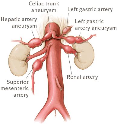 Visceral Aneurysm | UVA Health