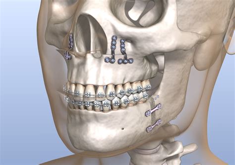 Jaw Surgery l Lancaster, PA l Conestoga Oral Surgery