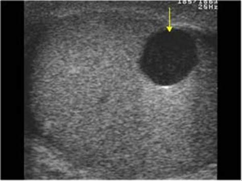 Scrotal Cysts Ultrasound