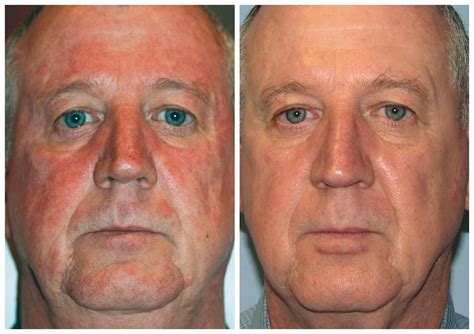 Rosacea Treatment Before And After