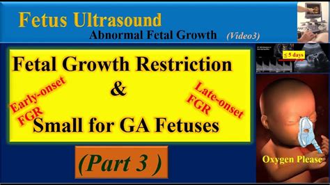 Fetus Ultrasound Fetal Growth Restriction And Small For Gestational