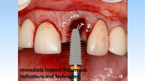 Immediate Implant Placement Indications And Techniques By Mohamed