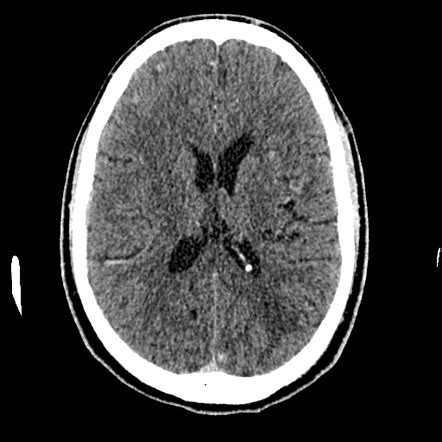 Cysticercosis Radiology Case Radiopaedia Org