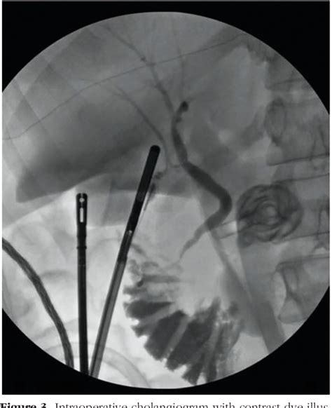 Figure From A Type V Aberrant Right Hepatic Duct Branching From The