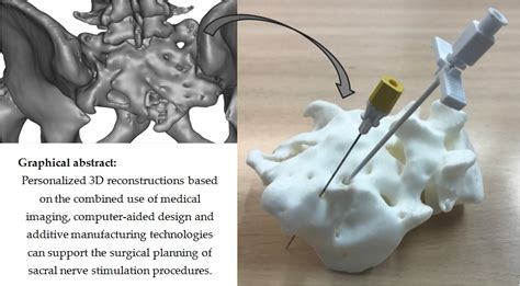 Polymers Free Full Text Surgical Planning Of Sacral Nerve Stimulation Procedure In Presence