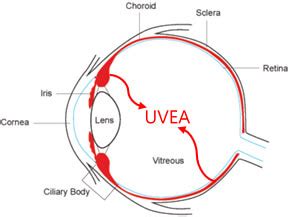 Uveitis: Causes, Symptoms, Diagnosis & Treatment at Neoretina