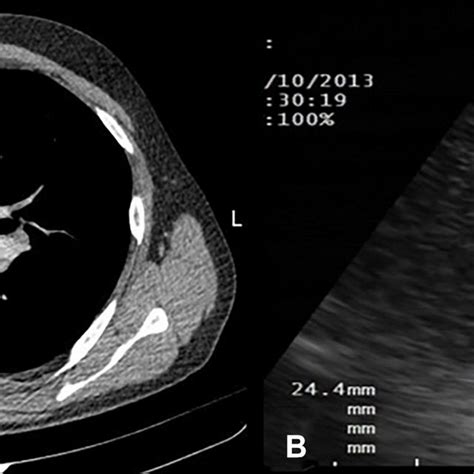 Thorax computed tomography revealed subcarinal lymph node (A). The view... | Download Scientific ...