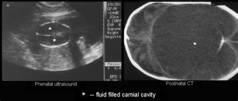 Fetal Porencephaly