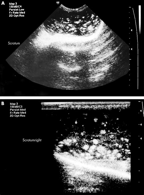 Fetal Meconium Peritonitis The Vanishing Hydrocele Sign ADC Fetal