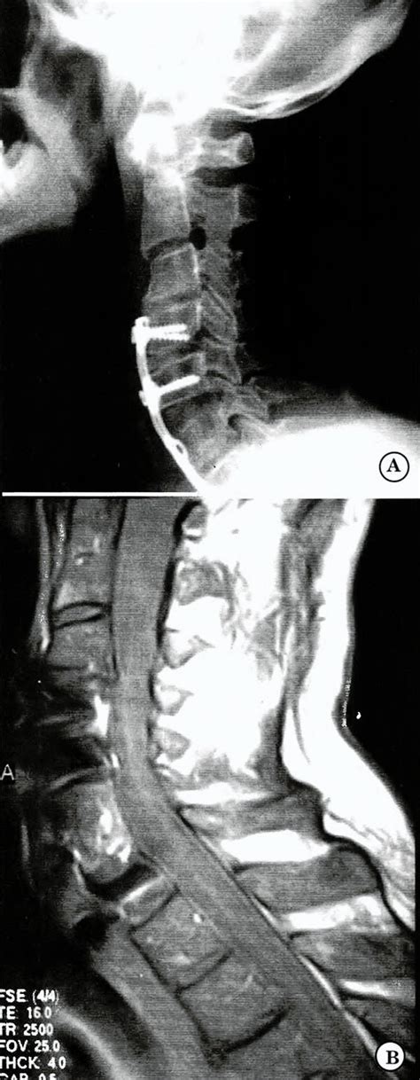 Mielopatía Cervical Espondilotica · Revista Argentina De Neurocirugia