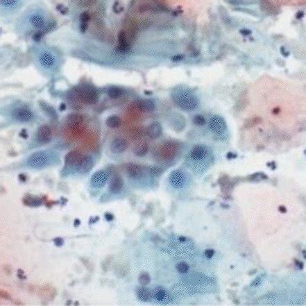 A Cervical Intraepithelial Neoplasiamild Dysplasia B Cervical