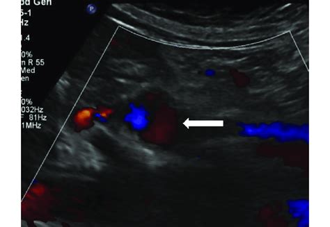 Duplex ultrasound scan depicting recanalized splenic artery aneurysm ...