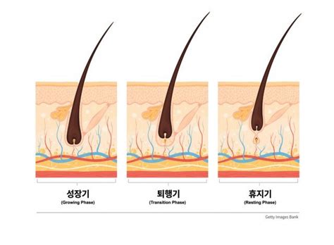 남자 휴지기 탈모 회복 집에서 간편하게 하는 비결과 현실적인 회복 방법