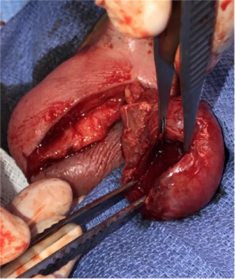 Left Testicular Abscess Cavity Download Scientific Diagram