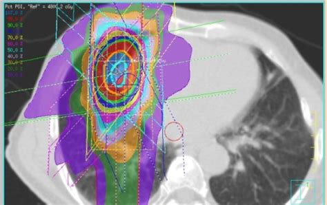 SBRT SABR Stereotactic Body Ablative Radiosurgery Blue Ridge