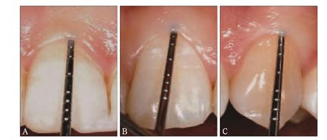 Gingival Biotype And Assessment Methods