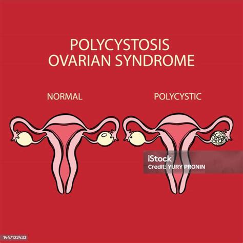 Polycystic Ovarian Syndrome Vs Normal Reproductive System Stock