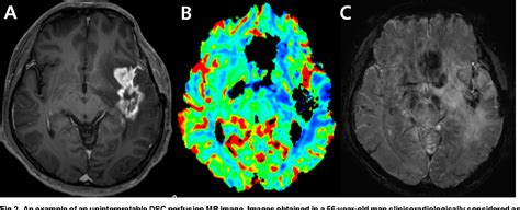 Figure From Uninterpretable Dynamic Susceptibility Contrast Enhanced