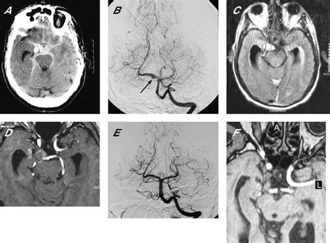 Third Nerve Palsy Heralding Dissecting Aneurysm Of Posterior Cerebral