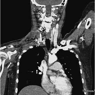 A Follow Up Contrast Enhanced Computed Tomography Scan At Years After