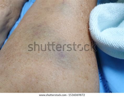 Skin Disease Lesion Ecchymosis Vasculitis Stock Photo