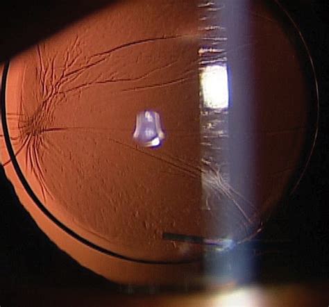 Online VA Tool Can Screen Post Op Cataract Patients