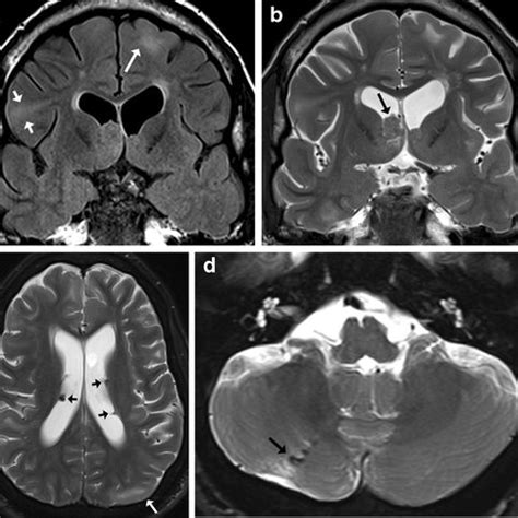 Lobar (localized) megalencephaly in a 4-year-old girl. Axial (a ...