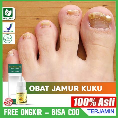 Jual Obat Jamur Kuku Cantengan Di Tangan Kaki Banyak Dicari Herbal