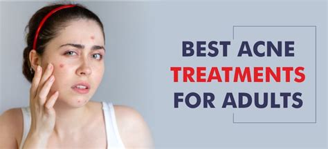 Get Rid Of Acne 15 Home Remedies For Pimples The Dreamer