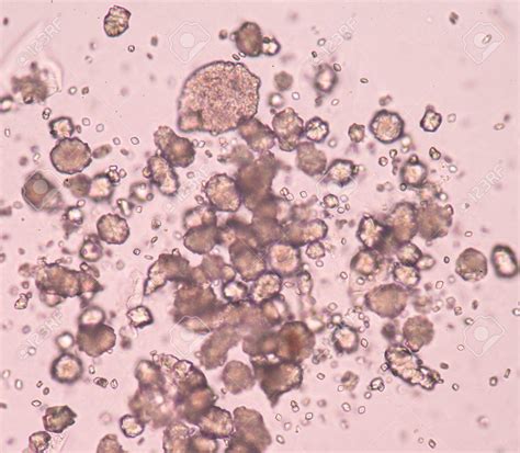 Detail Gambar Uric Acid Dalam Sedimen Urin Koleksi Nomer