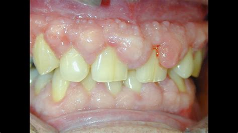 Gingival Overgrowthenlargement By Drugs Periodontal Surgery Youtube