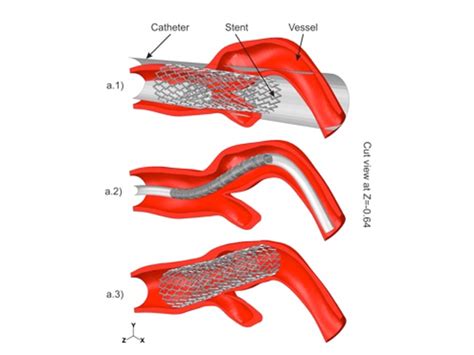 Carotid Artery Stenting Simulation From Dicom To Fea Compmech