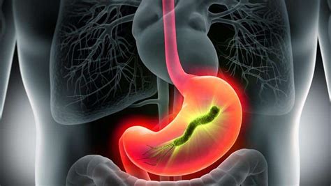 Helicobacter Pylori Bacteria En El Est Mago Causas S Ntomas Y