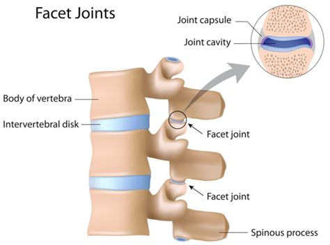 Lumbar facet syndrome causes, symptoms, diagnosis, treatment & prognosis