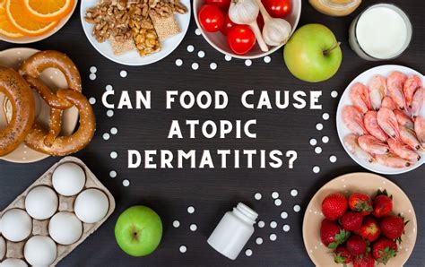 Can Food Cause Atopic Dermatitis Kind Of Heaven