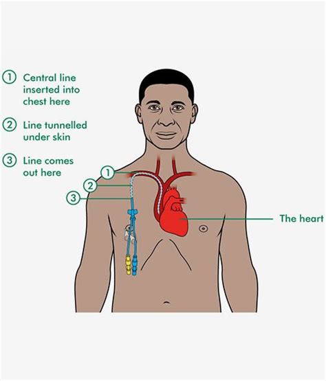 Hickman line, PICC line insertion for Bone – Dr. Kushan Nanavati – Vascular & Endovascular ...