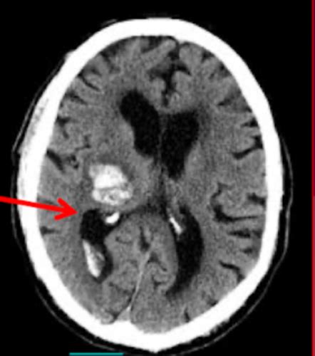 Imaging Stroke Flashcards Quizlet