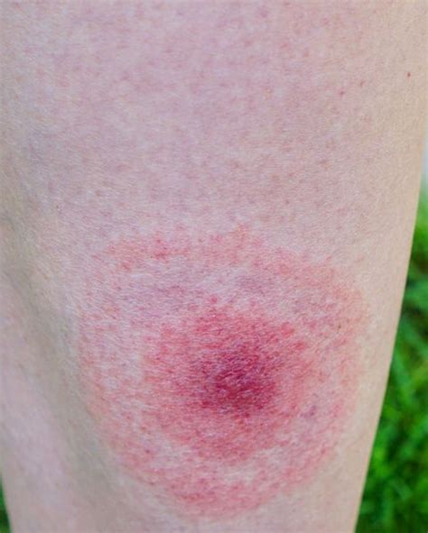 These Pictures Will Help You Id The Most Common Bug Bites And Their